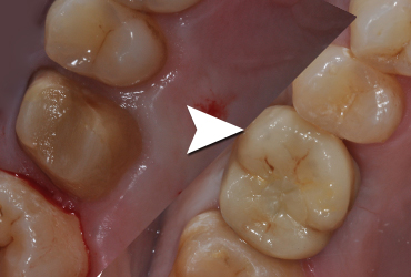 Riabilitazione implanto-protesica del primo molare superiore destro